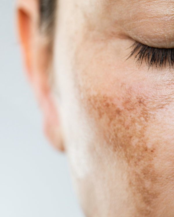 Hyperpigmentation
