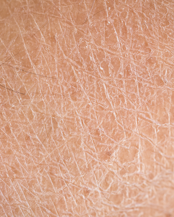 Dryness & Dehydration